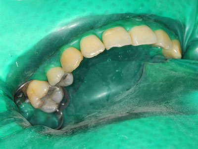 ���񋸐�,�O��,����,�摜,����,����,����,���@,����,GVBDO,G.V. BLACK DENTAL OFFICE