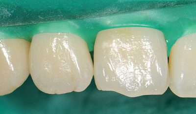 ���񋸐�,�O��,����,�摜,����,����,����,���@,����,GVBDO,G.V. BLACK DENTAL OFFICE