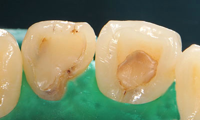 ���񋸐�,�O��,����,�摜,����,����,����,���@,����,GVBDO,G.V. BLACK DENTAL OFFICE