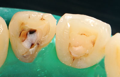 ���񋸐�,�O��,����,�摜,����,����,����,���@,����,GVBDO,G.V. BLACK DENTAL OFFICE