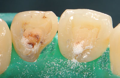 ���񋸐�,�O��,����,�摜,����,����,����,���@,����,GVBDO,G.V. BLACK DENTAL OFFICE