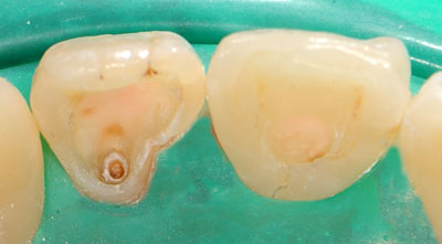 ���񋸐�,�O��,����,�摜,����,����,����,���@,����,GVBDO,G.V. BLACK DENTAL OFFICE