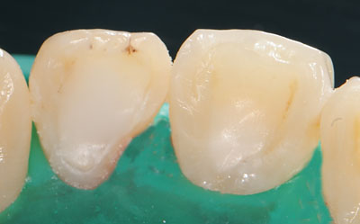 ���񋸐�,�O��,����,�摜,����,����,����,���@,����,GVBDO,G.V. BLACK DENTAL OFFICE