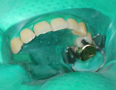 ���񋸐�,�O��,����,���Õ��@,���W���{���f�B���O,�摜,GVBDO,G.V. BLACK DENTAL OFFICE