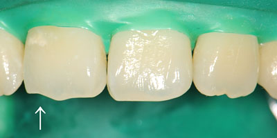 ���񋸐�,�O��,����,���Õ��@,���W���{���f�B���O,�摜,GVBDO,G.V. BLACK DENTAL OFFICE