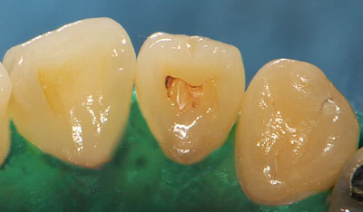 ���񋸐�,�O��,����,���Õ��@,���W���{���f�B���O,�摜,GVBDO,G.V. BLACK DENTAL OFFICE