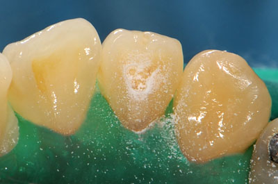���񋸐�,�O��,����,���Õ��@,���W���{���f�B���O,�摜,GVBDO,G.V. BLACK DENTAL OFFICE
