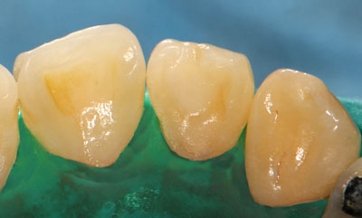 ���񋸐�,�O��,����,���Õ��@,���W���{���f�B���O,�摜,GVBDO,G.V. BLACK DENTAL OFFICE