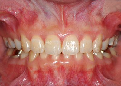 ���񋸐�,�O��,����,���Õ��@,���W���{���f�B���O,�摜,GVBDO,G.V. BLACK DENTAL OFFICE